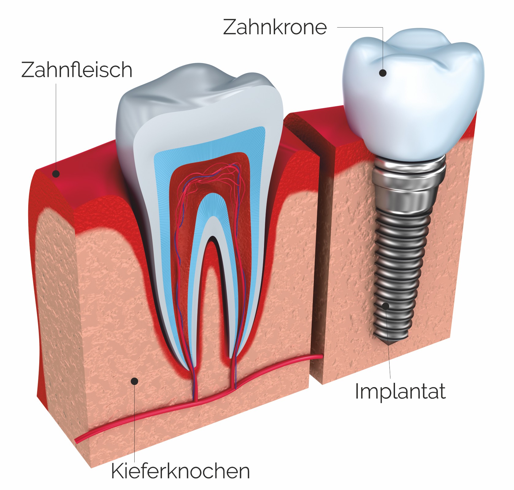 Zahnarztpraxis Roetgen Implantologie Implant Beispiel