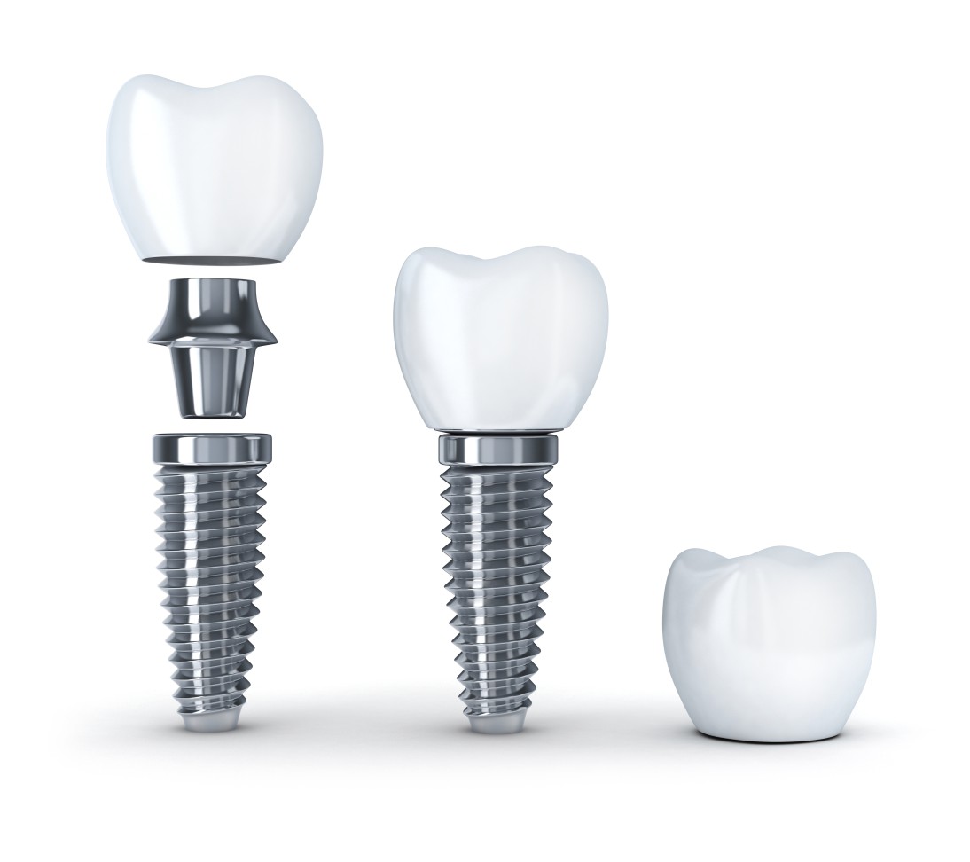 Zahnarztpraxis Roetgen Implantologie Implante Teile