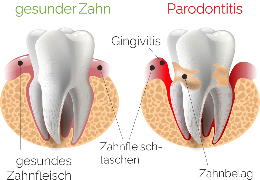 Zahnarztpraxis Roetgen Parodontologie Gingivitis