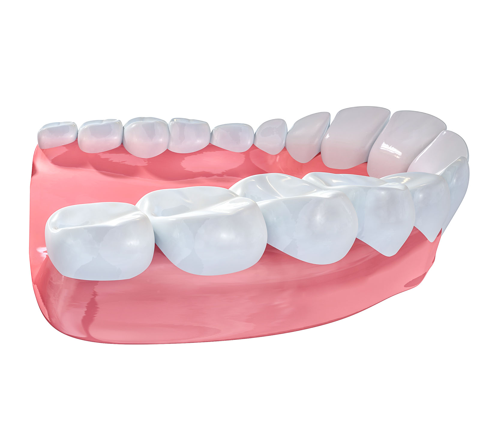 Zahnarztpraxis Roetgen - Vollkeramik - Beispiel Kiefer