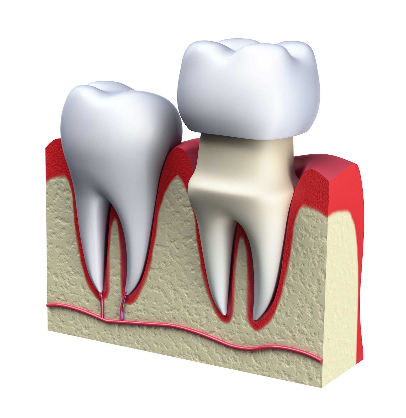 Zahnarztpraxis Roetgen - Vollkeramik - Beispiel aufsetzen