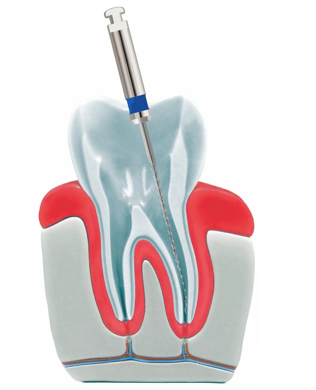Zahnarztpraxis Roetgen Wurzelkanalbehandlung entfernen Wurzel
