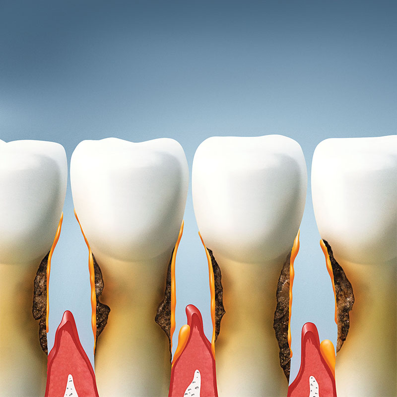 Zahnarztpraxis-Roetgen-Parodontitis-Entzündung