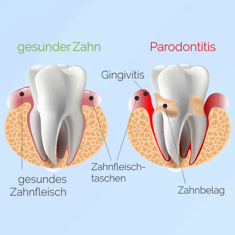 Zahnarztpraxis-Roetgen-Parodontologie-Gingivitis
