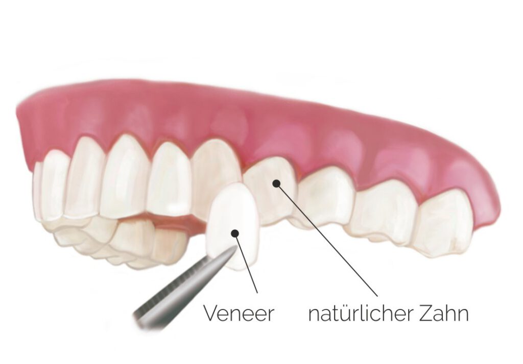 Zahnarztpraxis-Roetgen-Veneer-Montage