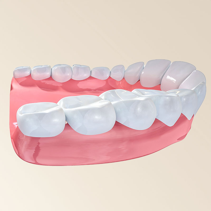 Zahnarztpraxis-Roetgen-Vollkeramik-Beispiel-Kiefer
