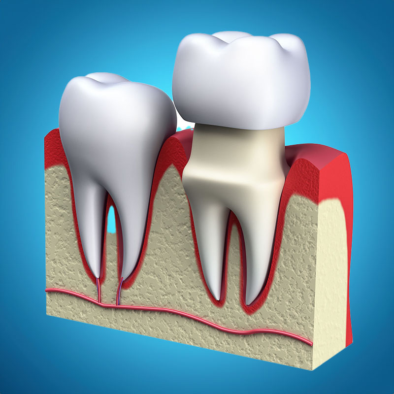 Zahnarztpraxis-Roetgen-Vollkeramik-Beispiel-aufsetzen