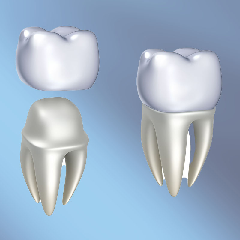 Zahnarztpraxis-Roetgen-Vollkeramik-Einsatz