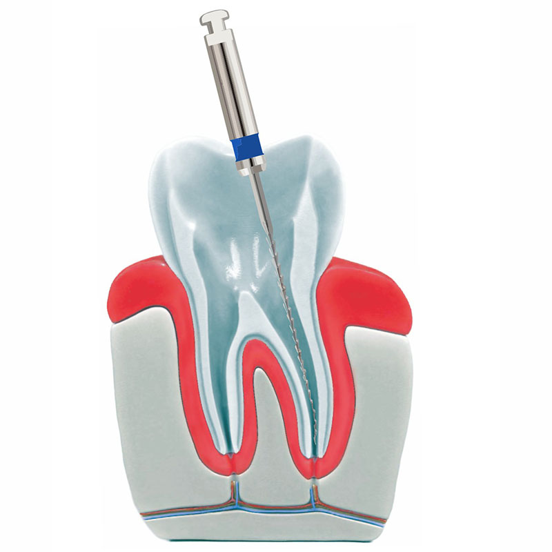 Zahnarztpraxis-Roetgen-Wurzelkanalbehandlung-entfernen-Wurzel